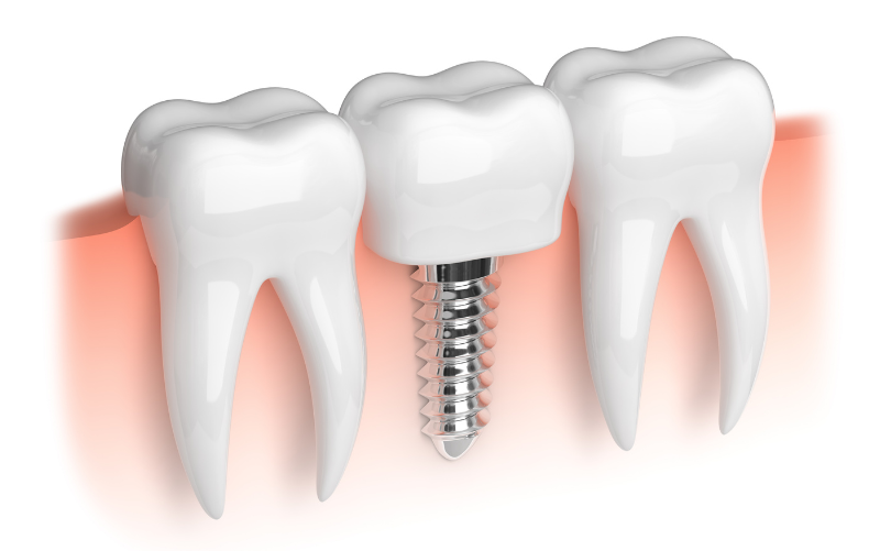 how much do 3 on 6 dental implants cost