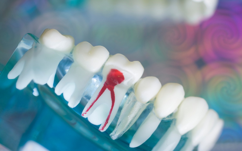 signs you need a root canal