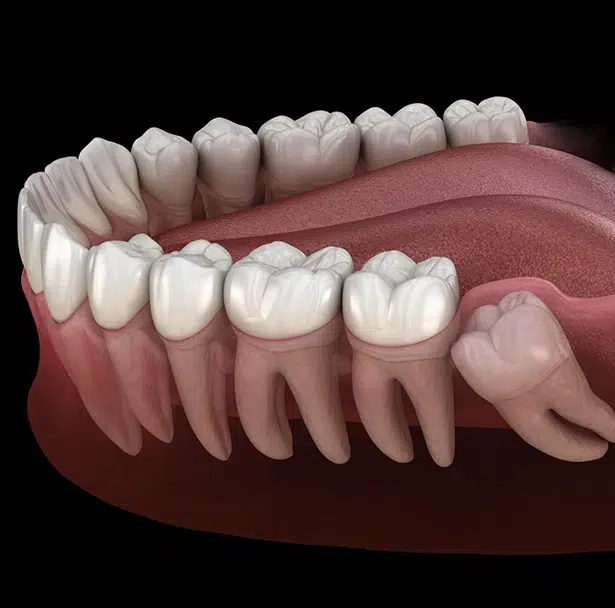 wisdom teeth removal in union - duo dental group
