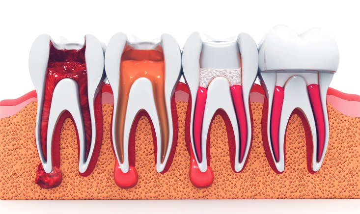 How Long Does It Take to Heal from a Root Canal?