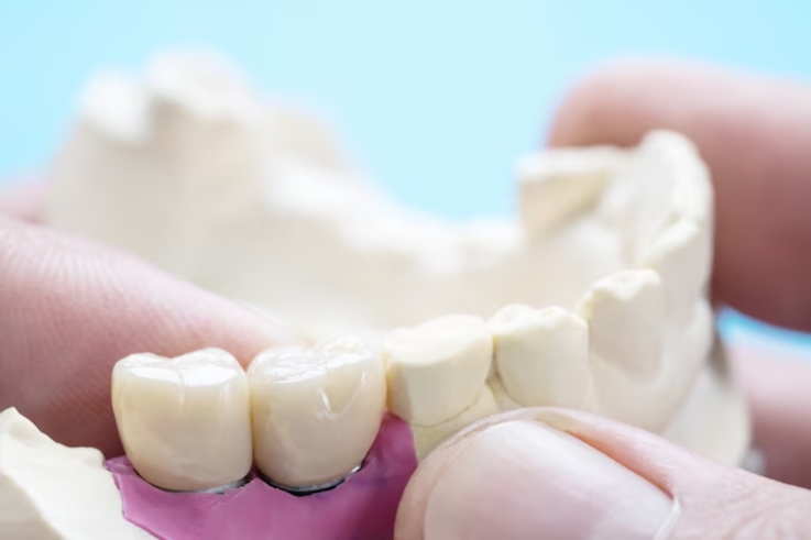 How To Care For Your Dental Bridge
